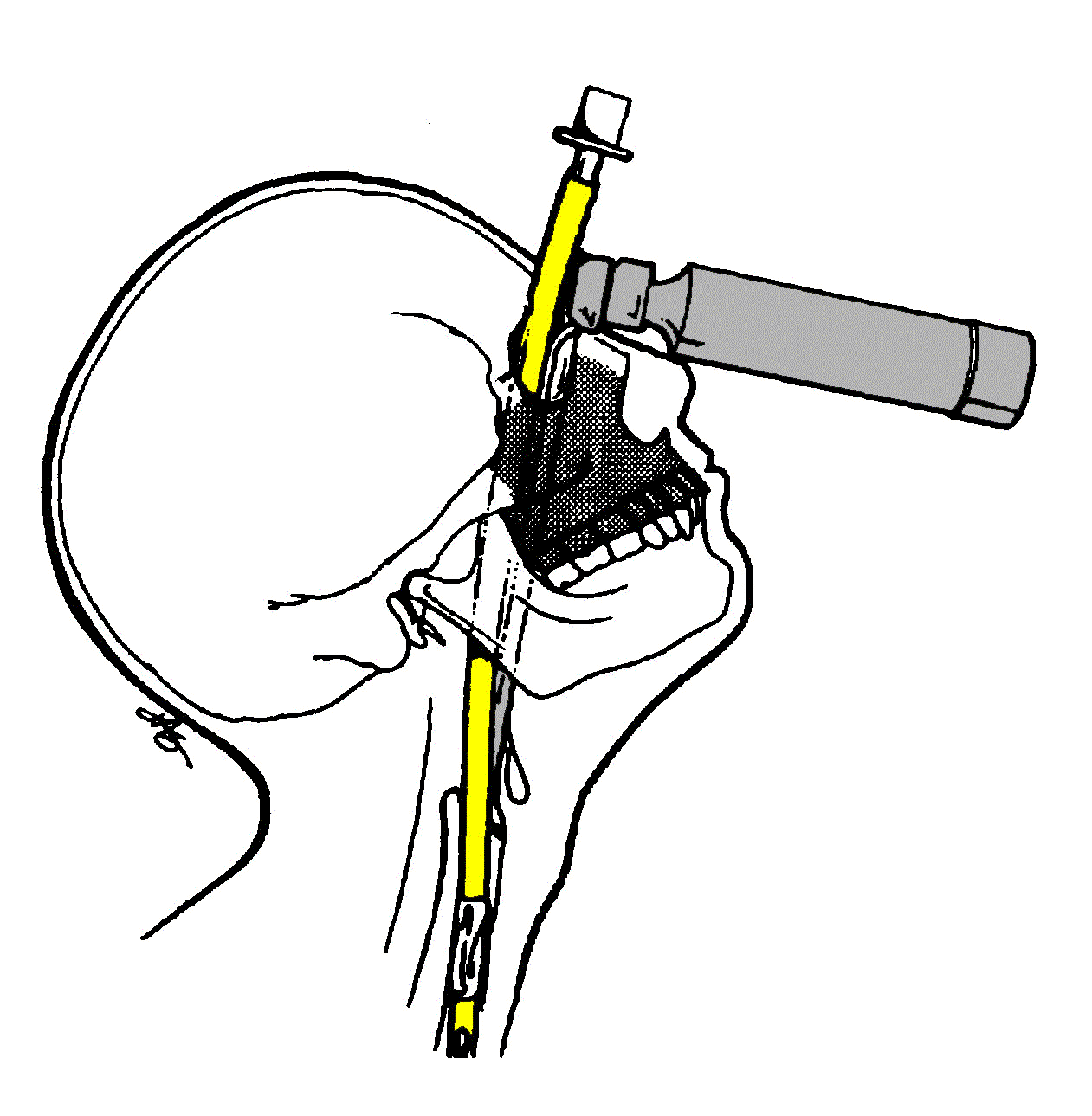 Airway Management for Maxillofacial Surgery